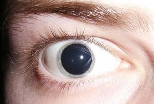 Mydriasis (kitágult pupilla) (mydriasis) Mydriasis (kitágult pupilla)