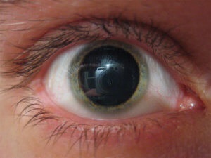 Mydriasis (kitágult pupilla)