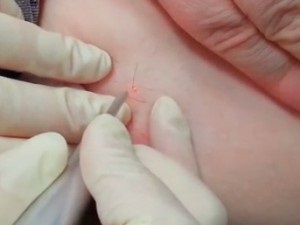 Az anyajegyek képek (Red anyajegyek fotó) Moles fotó