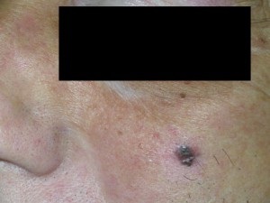 Az anyajegyek képek (Red anyajegyek fotó) Moles fotó