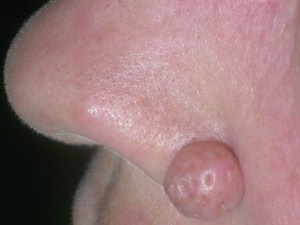 Az anyajegyek képek (Moles arc fotó) Moles fotó