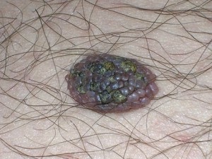 Az anyajegyek képek (Red anyajegyek fotó) Moles fotó