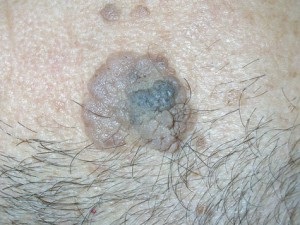 Az anyajegyek képek (Moles arc fotó) Moles fotó