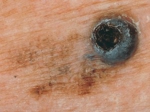 Az anyajegyek képek (mol) Moles fotó