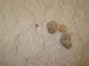 Anyajegyek fotó (Mole eltávolítása lézer) Moles fotó
