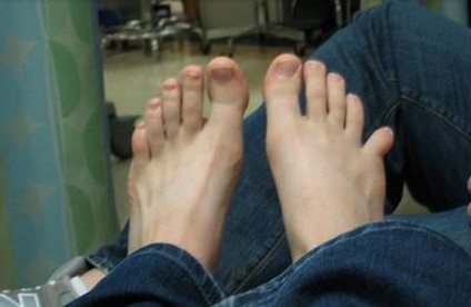 láb kisujj törés ízületi fájdalom a csípőben milyen kezelés