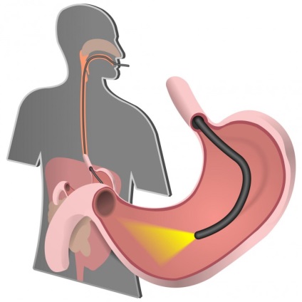 Csúszó hiatus hernia okai, tünetei, diagnózis,