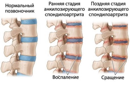 Spondylarthrosis mi ez, mennyit és hogyan kell kezelni (fénykép, videó)