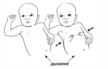 Zihálás (sípoló légzés) veleszületett gyermekeknél, újszülöttek