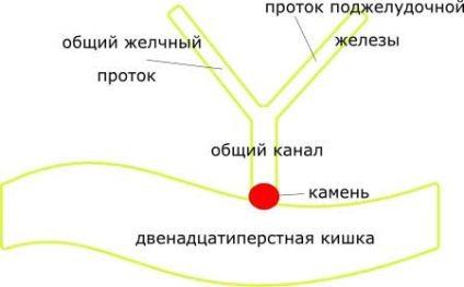 Elmélet közös csatornát (heveny hasnyálmirigy-gyulladás keletkezik) Az elmélet a közös csatornán