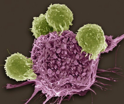 Most a rák esélye sincs egy új felfedezés a rosszindulatú daganatok kezelésében