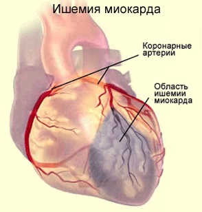 Egy tipikus formája a szívinfarktus, a fő jellemzője