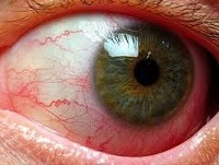 Tuberkulózis szemek - okai, tünetei, diagnózisa és kezelése
