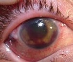 Tuberkulózis szemek - okai, tünetei, diagnózisa és kezelése
