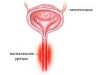 Uretroprostatit azaz a tünetek, a kezelés