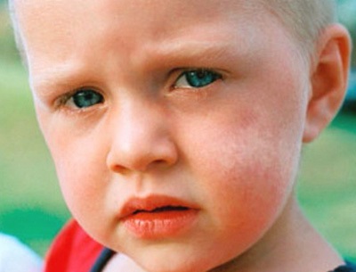 Vitiligo gyermekeknél okoz, a kezelés kezdeti szakaszában a csecsemő és grudnichka