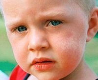 Vitiligo gyermekeknél okoz, a kezelés kezdeti szakaszában a csecsemő és grudnichka