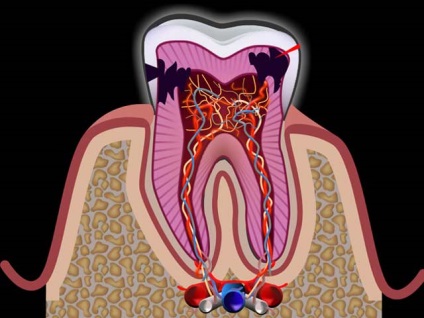 Gyulladás a fogászati ​​ideg hogyan enyhíti a fájdalmat otthon