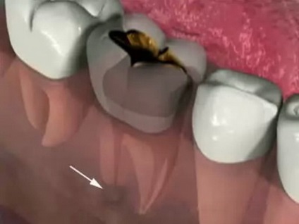 Gyulladás a fogászati ​​ideg hogyan enyhíti a fájdalmat otthon