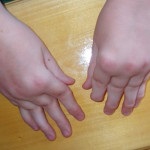 Krónikus fiatalkori arthritis kezelésére gyermekeknél