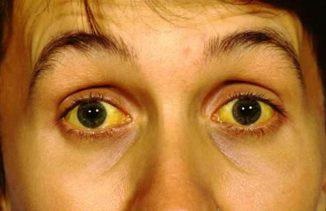 Sárga karikák a szem körül a nők okok, ami azt jelenti, hogy hogyan kell kezelni
