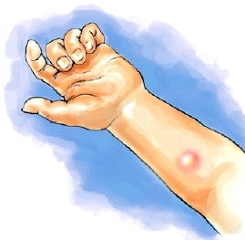 Az allergia bőrteszt a gyermek tünetei allergiás reakció után Mantoux teszt