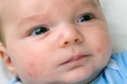 Allergiás a kamillatea felnőttek és gyermekek számára, tünetek, kezelés
