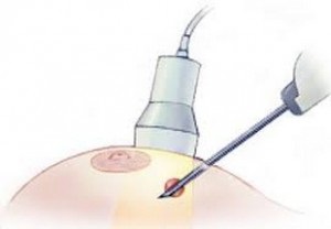 Biopsziás (szúrás) Breast