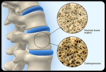 Fájdalom osteoporosis mik a tünetei, kezelése gyógyszerek nélkül