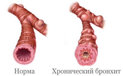 Bronchitis és pneumonia különbségek