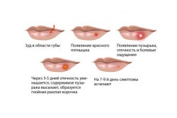 Mi van, ha a herpesz a száj nem felel meg egy hónap alatt hogyan lehet csökkenteni az akut fázis herpesz