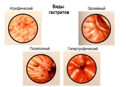 Diéta erozív gyomorhurut jobb oldali menüben