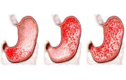 Az eróziós gastroduodenitis kezelés népi jogorvoslati