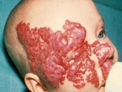 Hemangioma - azaz, az okok a felnőttek és gyermekek, hemangioma a májban, az orr, bőr