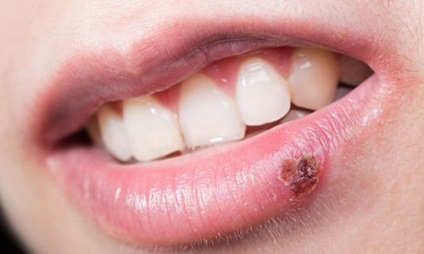 Herpes az ajkak okait és kezelését