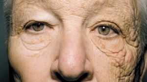 Hyperkeratosisát bőr tünetei és kezelése