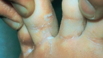 Gombák lábai között kezelés gyógyszerek ujjaival népi jogorvoslati otthon
