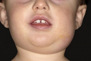 A fertőző betegségek mumpsz tünetei, kezelése és megelőzése