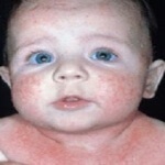 A mononucleosis infectiosa gyermekek tünetei, kezelése, fotó, videó