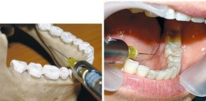 Intraligamentarnaya érzéstelenítés a fogászatban - Leírás és előnyök