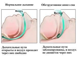 Hogyan lehet visszaállítani az ember, hogy megszabaduljon a horkolás gyógyszert és népi jogorvoslati