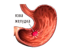 Hogyan készítsünk homoktövis olaj gyomorhurutos