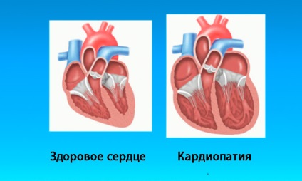 Cardiomyopathia gyermekeknél - okai és kezelése funkcionális, szekunder, és a veleszületett rendellenességek (gyermek) Cardiomyopathia gyermekeknél - okozza és a kezelés a funkcionális, szekunder és veleszületett rendellenességek