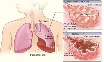 Lebenyes tüdőgyulladás tünetei, okai, kezelése