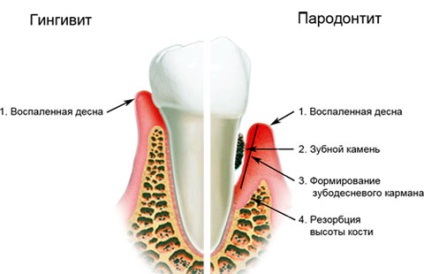 A periodontális betegségek kezelésében a tünetek, fotók, fajok