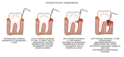 A periodontális betegségek kezelésében a tünetek, fotók, fajok