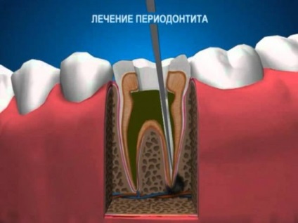 Paradentózis gyógyítása lépésre íny szekcionált fogászat