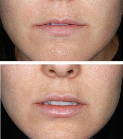 Lipofilling ajkak (zsírkorrekció) - eljárást, az árak, vélemények, fotók