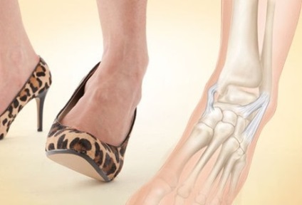 Március törés láb (deychlendera betegség) kezelésére, a tünetek