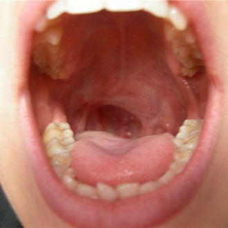 Lehet a beteg torkán egy fogat